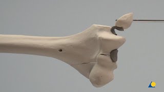 Humerus Distal—Lateral Condyle and Medial Epicondyle Fractures [upl. by Atteroc456]