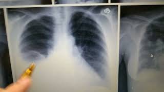 Pulmonology Radiology Pleural Effusion Chest Xray Loss Of Costophrenic Angle [upl. by Hotze372]