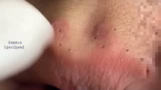 Acne on Forehead  Blackhead Removal on his forehead  Acne Treatment removeblackhead [upl. by Mehcanem]