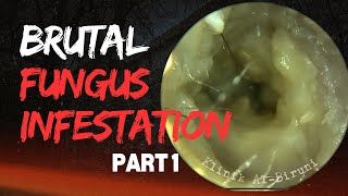 BRUTAL Fungus Infestation Due To Physician Mistake  PART 1 [upl. by Rebeca687]