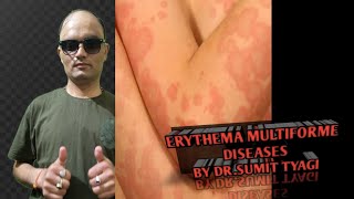 ABOUT THE ERYTHEMA MULTIFORME BY DRSUMIT TYAGISUMITMEDICALDISPENSARY1 [upl. by Loss922]