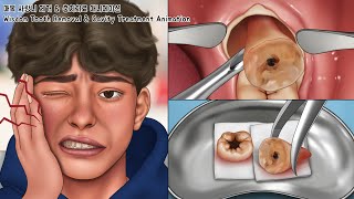 ASMR 매복 사랑니 제거 amp 충치치료 풀버전  치아미백  Wisdom Tooth amp Cavity Treatment Animation [upl. by Fredrick]