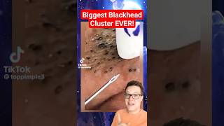 BIGGEST BLACKHEADS REMOVAL EVER  Extreme Blackheads on Cheek shorts [upl. by Harod703]