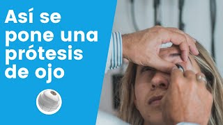 Prótesis Oculares Colocación de la prótesis de ojos [upl. by Atnoid]