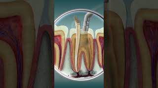 Root Canal Treatment  Curveia Dental I RCT [upl. by China]