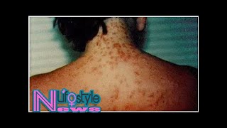 Sea Lice Outbreak Causing Discomfort On Beaches [upl. by Mosora794]