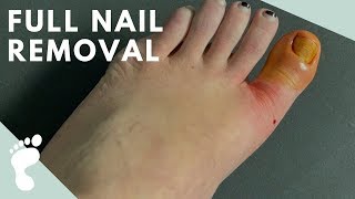 Complete Toenail Avulsion [upl. by Kuehn]