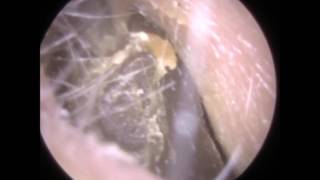 Huge Lump of Dry Ear Wax Extracted  Mr Neel Raithatha The Hear Clinic [upl. by Halbert]