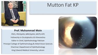 Mutton Fat Keratic Precipitates [upl. by Eulau452]