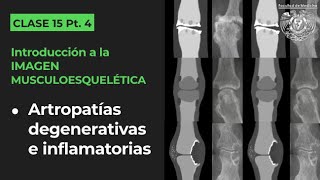 154  Artropatías degenerativas e inflamatorias osteoartritits artritis reumatoide gota etc [upl. by Franni]