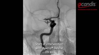 Acute ischaemic stroke treatment Acandis Aperio® Thrombectomy Device [upl. by Swanson]