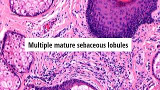 Pathology of Folliculosebaceous Cystic Hamartoma by Dr Sampurna Roy MD [upl. by Sanger]