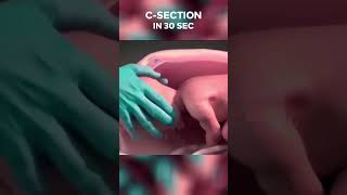 3D सिजेरियन डिलीवरी 30 sec में A quick look at Csection birth cesareandelivery pregnancy baby [upl. by Iphagenia999]