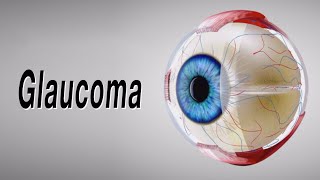 Glaucoma Animation of Why It Happens and How It Can Cause Blindness [upl. by Niatsirt692]