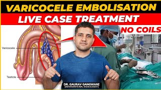 Live Varicocele embolisation case 2  Without any metal coils  Dr Gaurav Gangwani IR [upl. by Owiat489]