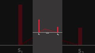 Aortic Stenosis [upl. by Jeffrey]