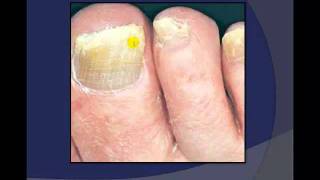 Toenail Debridement by a Podiatrist [upl. by Alleacim]