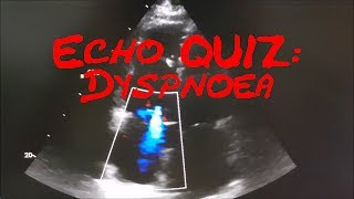 Cardiology Echo QuizCase Which EchoSign do you see here and what is your diagnosis [upl. by Machutte]