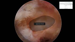 Neurogenic Claudication [upl. by Egerton]