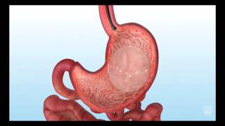 Endoscopic Gastric Balloon for Bariatric Weight Loss [upl. by Tabor]