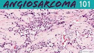 Angiosarcoma 101 for Pathologists and Dermatologists [upl. by Attikin]