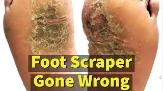 Full foot callus removal  Epidermolytic Palmoplantar Keratoderma  Jan 30 2023 [upl. by Kopple]