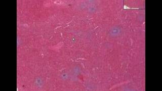 Histopathology SpleenHereditary spherocytosis [upl. by Eiramanin]