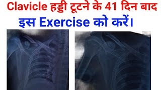 Clavicle fracture best exercises At home Full recovery 2 months [upl. by Dustan]