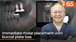 Immediate molar placement with buccal plate loss [upl. by Hooper578]