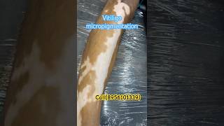 VITILIGO MICROPIGMENTATION TATTOO COVERUP  vitiligo permanent cure vitiligo skin disease treatment [upl. by Lawlor962]