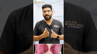 Understanding Oral Lichen Planus  Symptoms Causes and Care with Dr Dilip Kumar [upl. by Bonacci515]