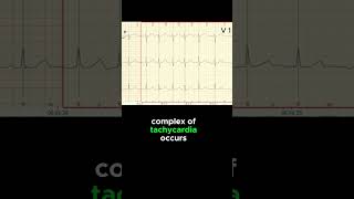 FOCAL ATRIAL TACHYCARDIA ECG EXAMPLE [upl. by Drahsar]