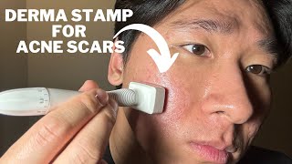 Will derma stamp get rid of my acne scars [upl. by Trey769]