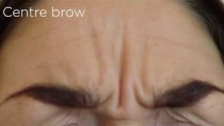 Botox removes Crows feet Centre Brow amp Forehead lines [upl. by Odessa]