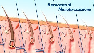 Alopecia Androgenetica il processo di Miniaturizzazione [upl. by Gothar692]