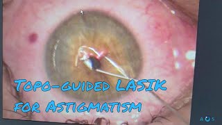 Contoura Vision Laser Eye Surgery for Astigmatism  Topographyguided LASIK PRK [upl. by Allimak585]