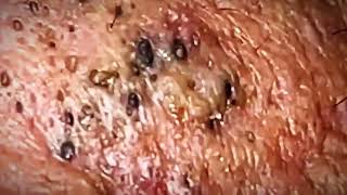 Most Satisfying Blackhead Removal 2024 [upl. by Eserahs686]