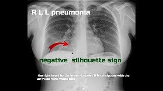 Basic semiology of chest radiology illustrated by clinical casesSilhouette Sign [upl. by Kahlil]