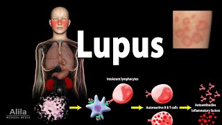 Lupus Symptoms Risk factors Pathophysiology Diagnosis and Treatments [upl. by Darahs]