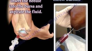 Aspiration Of Elbow Bursitis  Everything You Need To Know  Dr Nabil Ebraheim [upl. by Izawa903]