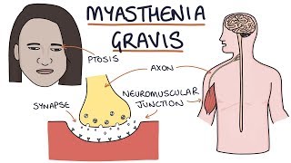 Myasthenia Gravis [upl. by Doyle625]