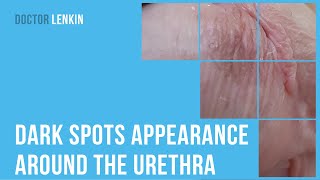 😕 Dark spots appearance around the urethra after treating chlamydial urethritis [upl. by Niwred]