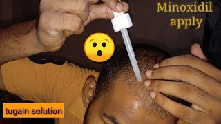 How To Apply Cipla Tugain Solution 5।Sonu Kumar Mishra। Minoxidilapply Minoxidilusevideo [upl. by Falcone]