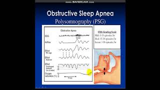 polysomnography [upl. by Padraig615]