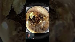 Suction and Irrigation Ear Wax Removal [upl. by Ayotal]