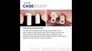 Case Study Using the CoAxis® INVERTA ® with the TOP abutment to restore tooth 7 and 8 [upl. by Aissatsana]