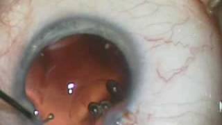 MICS implantation of the Bausch amp Lomb Akreos MI60 Lens Implant through a 18mm incision [upl. by Aical]