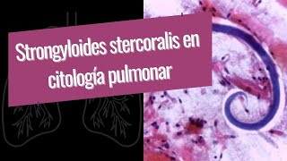 Strongyloides stercoralis en citología pulmonar [upl. by Enilkcaj]