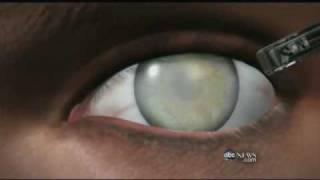 Medical Breakthrough Restoring Sight to the Blind [upl. by Rehpatsirhc146]