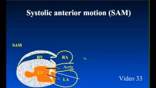 SAM  Systolic Anterior Motion in Feline Cardiomyopathy [upl. by Enelrihs]